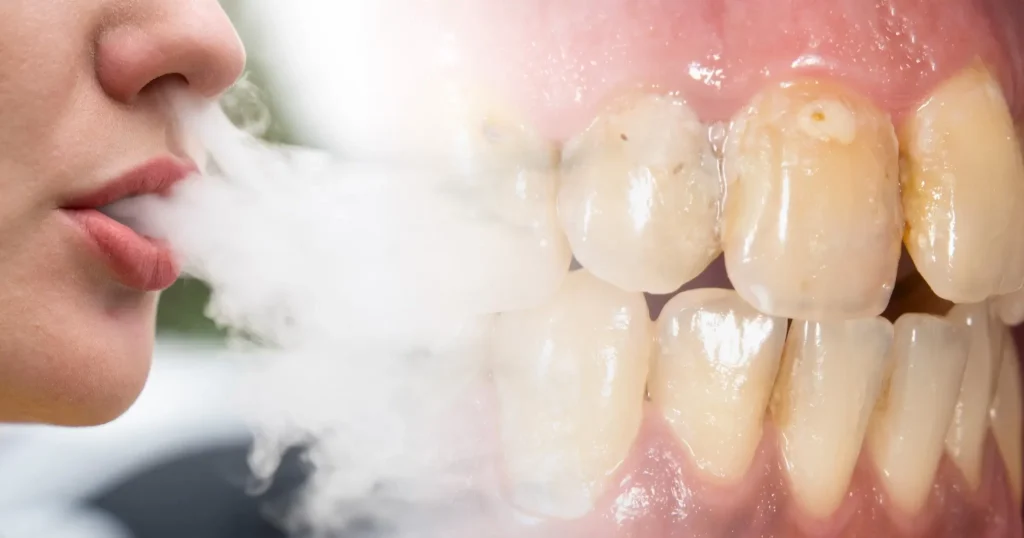 Is vaping bad for your teeth